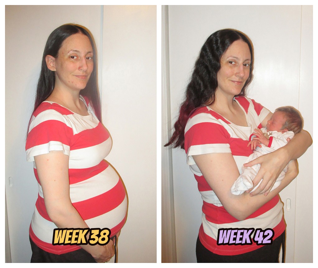 My Dermatillomania Challenges During Pregnancy