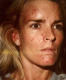 Famous People Who Pick Their Skin