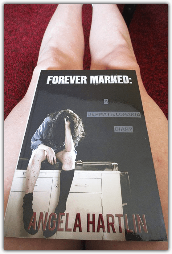 FOREVER MARKED: A Dermatillomania Diary